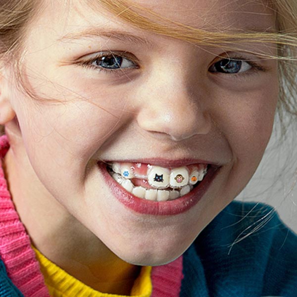 Child wearing Invisalign
